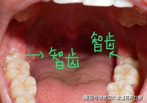 牙科私人贵还是医院贵拔智齿