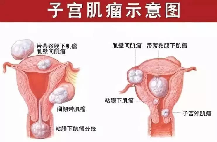 子宫肌瘤手术费用大概多少,子宫肌瘤手术费用解析与创造性方案探讨——YE版第64期,整体规划讲解_撤版12.97.76