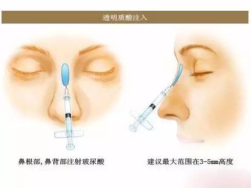 硅胶假体隆鼻视频