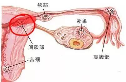 输卵管不孕最常见的病因