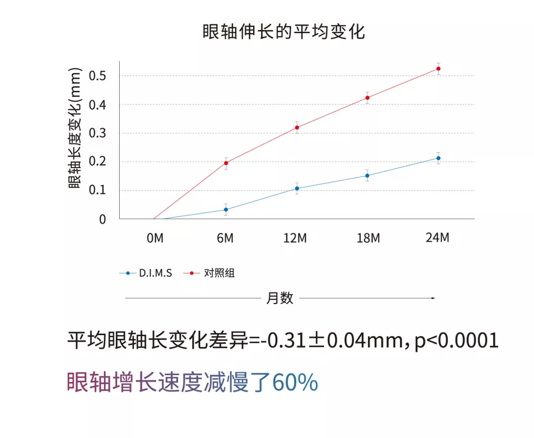 棱镜式组合透镜近视眼要配吗