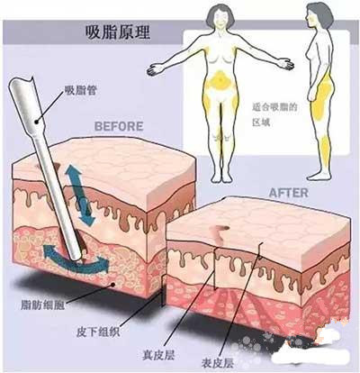 吸脂手术多久恢复正常