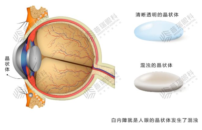 白内障眼睛手术费用