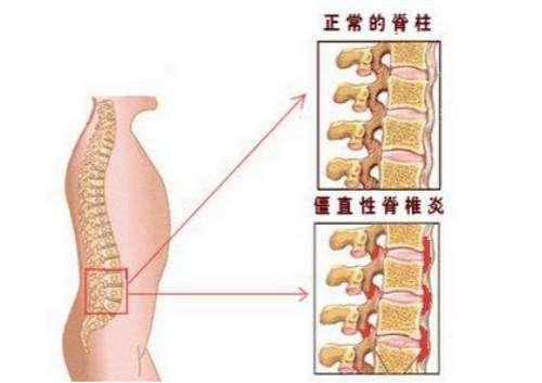 强直性脊柱炎能治好吗能活多久