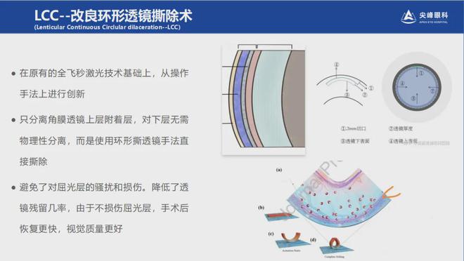 眼睛屈光手术的恢复时间是多长